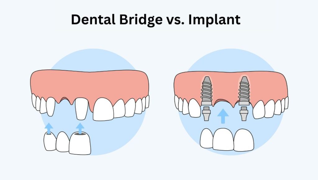 Dental Bridge vs. Implant: Find the Best Tooth Replacement Option