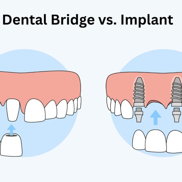 Dental Bridge vs. Implant